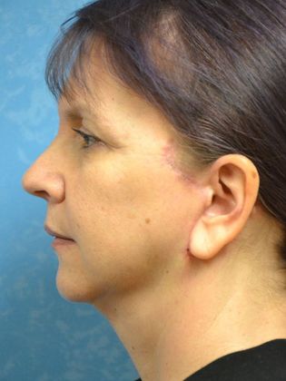 Face & Neck Lifts: Case 1502- Sherwood, OH - After