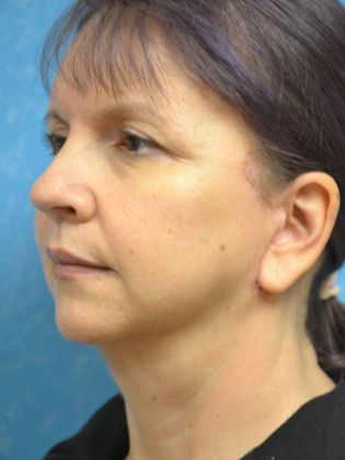 Face & Neck Lifts: Case 1502- Sherwood, OH - After