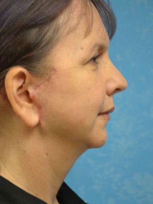 Face & Neck Lifts: Case 1502- Sherwood, OH - After