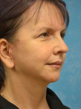 Face & Neck Lifts: Case 1502- Sherwood, OH - After