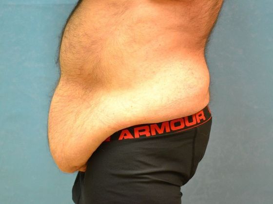 Tummy Tuck: Case 1682- Perrysburg, OH - Before