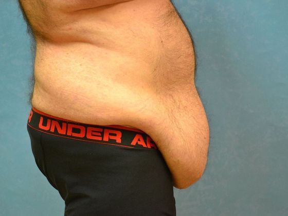 Tummy Tuck: Case 1682- Perrysburg, OH - Before