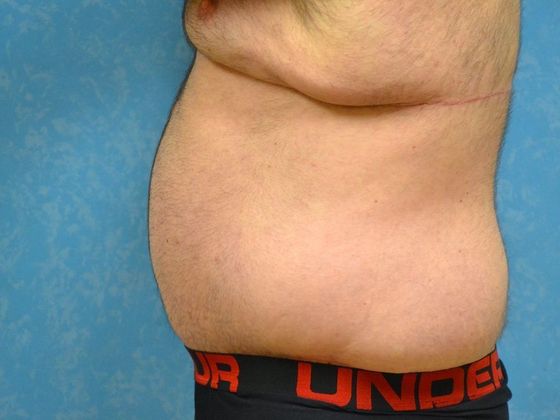 Tummy Tuck: Case 1682- Perrysburg, OH - After
