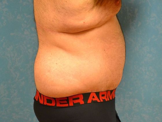 Tummy Tuck: Case 1682- Perrysburg, OH - After