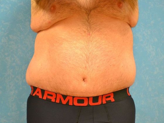 Tummy Tuck: Case 1682- Perrysburg, OH - After