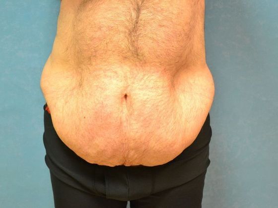 Tummy Tuck: Case 1682- Perrysburg, OH - Before