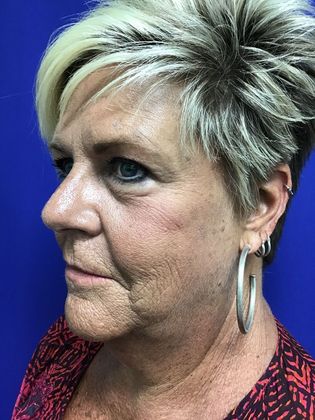 Facial Eyelid Surgery / Blepharoplasty: Case 10 (23224) - Before