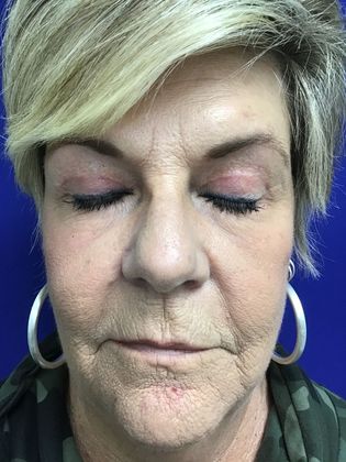 Facial Eyelid Surgery / Blepharoplasty: Case 10 (23224) - After, eyes closed