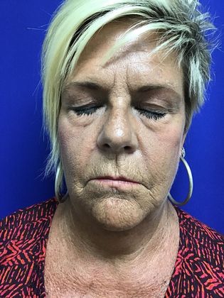 Facial Eyelid Surgery / Blepharoplasty: Case 10 (23224) - Before, eyes closed