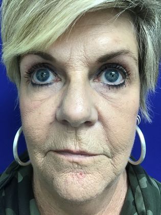Facial Eyelid Surgery / Blepharoplasty Case 10 (23224) - After