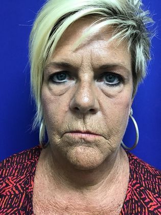 Facial Eyelid Surgery / Blepharoplasty Case 10 (23224) - Before