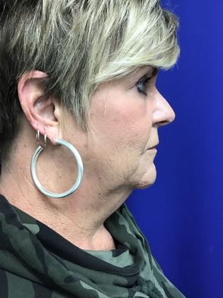 Facial Eyelid Surgery / Blepharoplasty: Case 10 (23224) - After