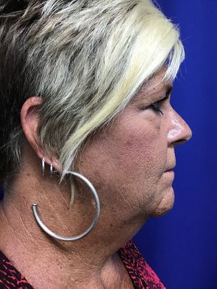 Facial Eyelid Surgery / Blepharoplasty: Case 10 (23224) - Before