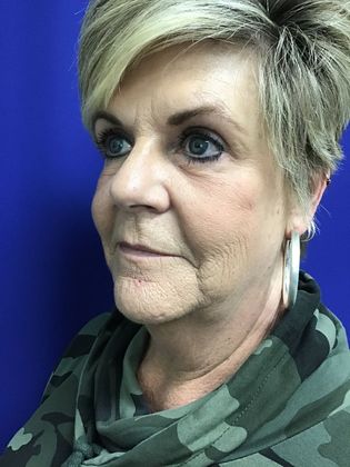 Facial Eyelid Surgery / Blepharoplasty: Case 10 (23224) - After