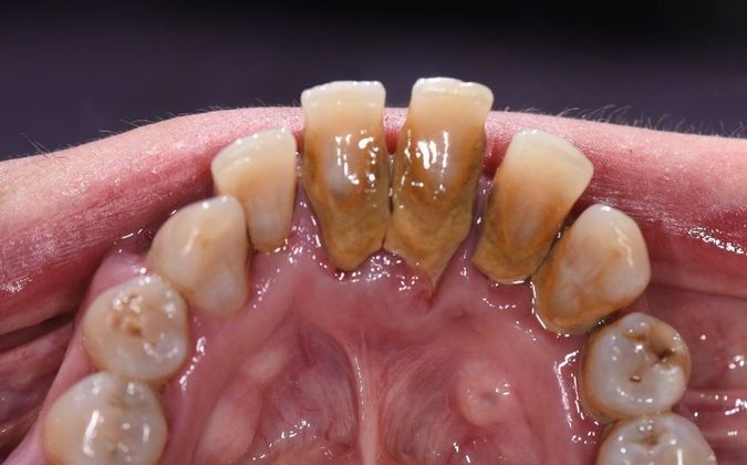 Periodontal Cleaning: Case 6 - Victoria, TX - Before