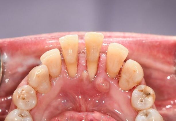 Periodontal Cleaning: Case 6 - Victoria, TX - After