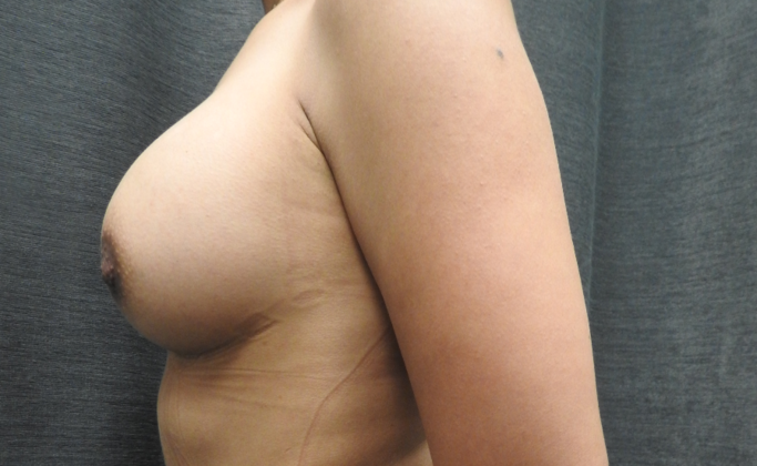 TUBA/Transumbilical Breast Augmentation: Case 13 - After