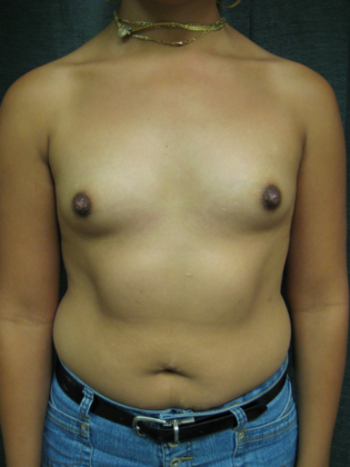 TUBA/Transumbilical Breast Augmentation Case 13 - Before