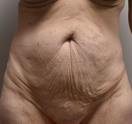 Tummy Tuck (Abdominoplasty): Case 217 - Before