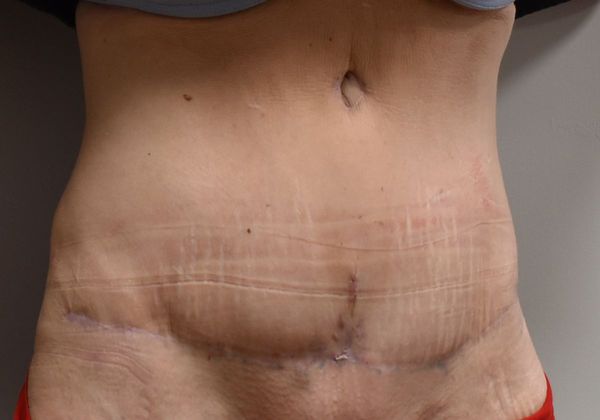 Tummy Tuck (Abdominoplasty): Case 217 - After