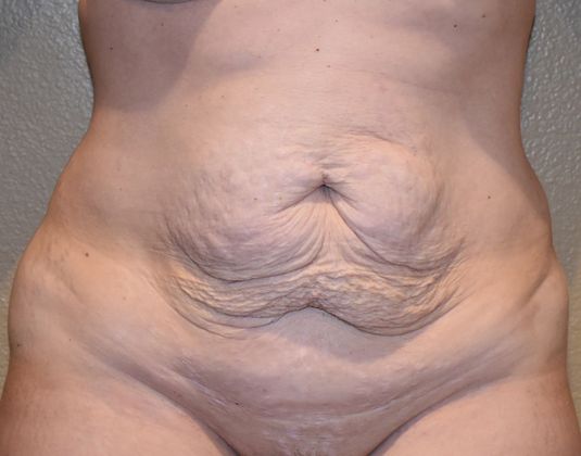 Tummy Tuck (Abdominoplasty): Case 218 - Before