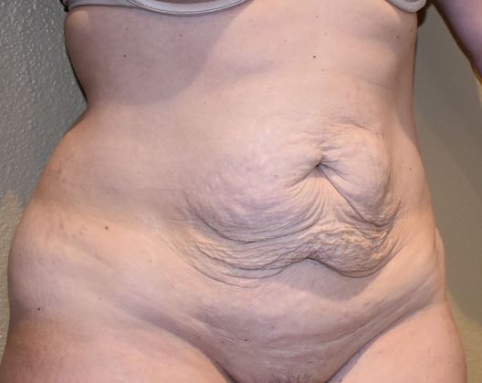 Tummy Tuck (Abdominoplasty): Case 218 - Before