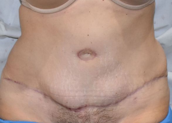 Tummy Tuck (Abdominoplasty): Case 218 - After