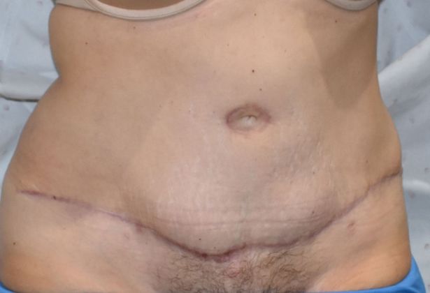 Tummy Tuck (Abdominoplasty): Case 218 - After