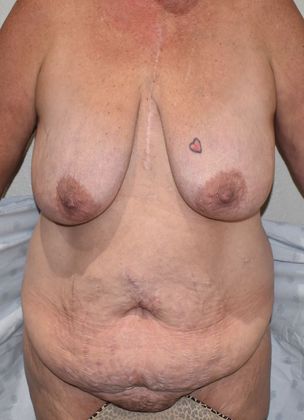 Mommy Makeover Case 149 - Before