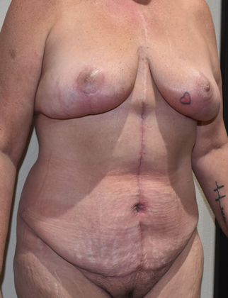 Mommy Makeover: Case 149 - After