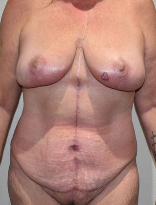 Massive Weight Loss : Case 64 - After