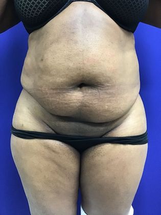 Body Tummy Tuck / Abdominoplasty: Case 19 (22876) - Before