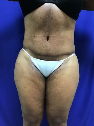Body Tummy Tuck / Abdominoplasty: Case 19 (22876) - After