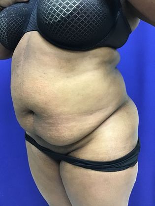 Body Tummy Tuck / Abdominoplasty: Case 19 (22876) - Before