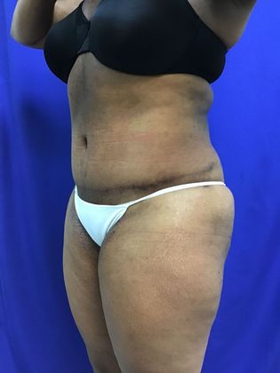 Body Tummy Tuck / Abdominoplasty: Case 19 (22876) - After