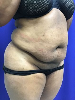 Body Tummy Tuck / Abdominoplasty: Case 19 (22876) - Before