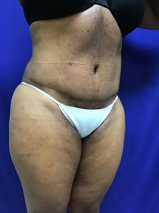 Body Tummy Tuck / Abdominoplasty: Case 19 (22876) - After