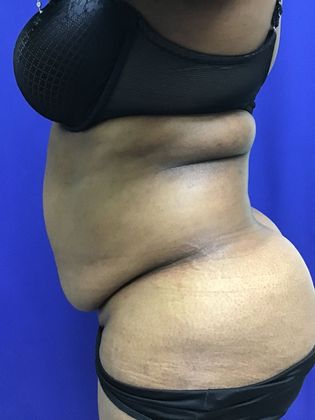 Body Tummy Tuck / Abdominoplasty: Case 19 (22876) - Before