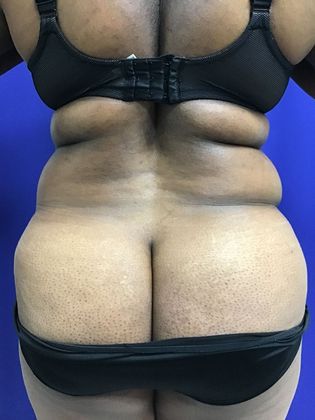 Body Tummy Tuck / Abdominoplasty: Case 19 (22876) - Before