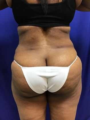 Body Tummy Tuck / Abdominoplasty: Case 19 (22876) - After