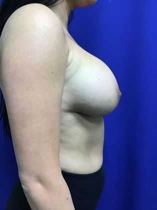 Breast Augmentation : Case 74 (20650) - After
