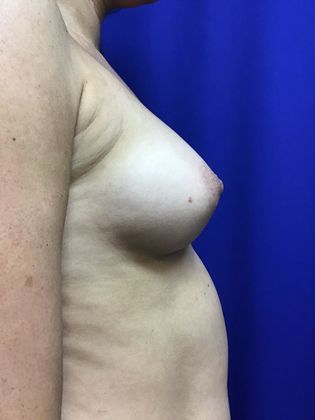 Breast Augmentation : Case 74 (20650) - After