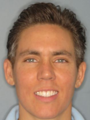 Invisalign - Invisible Braces: Adult Crowding - After