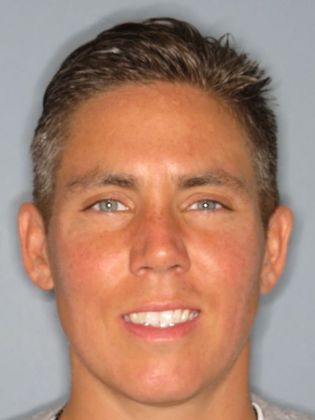 Invisalign - Invisible Braces: Adult Crowding - Before