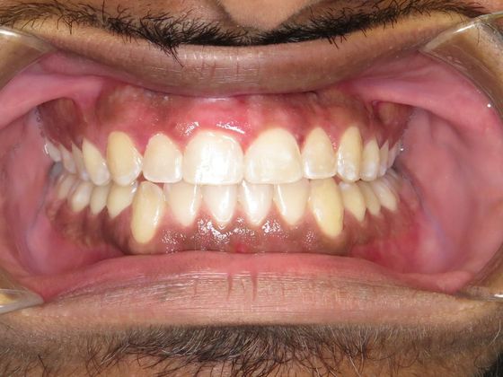 Invisalign - Invisible Braces: Under Bite - After