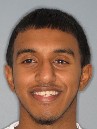 Invisalign - Invisible Braces: Under Bite - Before