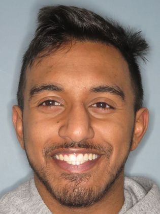 Invisalign - Invisible Braces: Under Bite - After