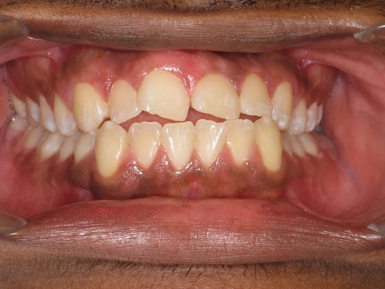 Invisalign - Invisible Braces: Under Bite - Before
