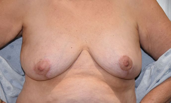 Breast Implant Removal: Case 2 - After
