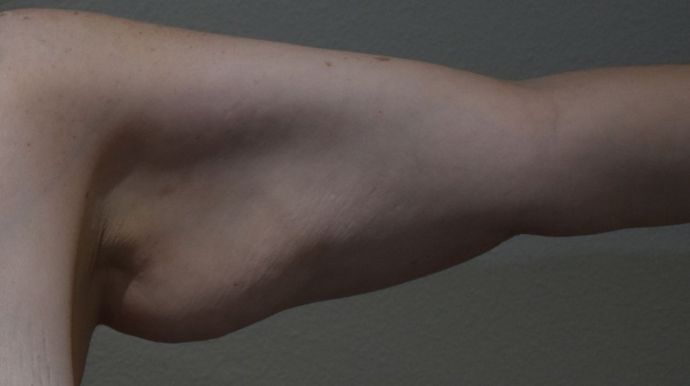 Brachioplasty Case 10 - Before